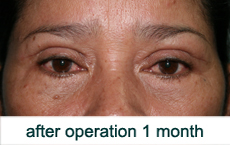 plastic-surgery-blepharoplasty